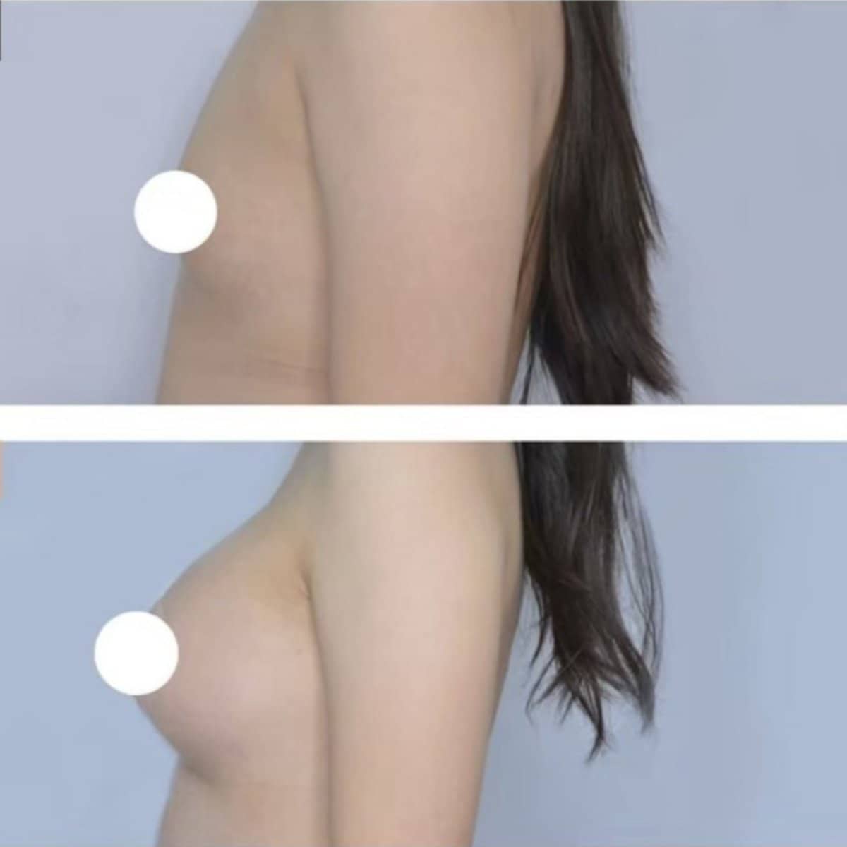 Case 20993 - breast augmentation
