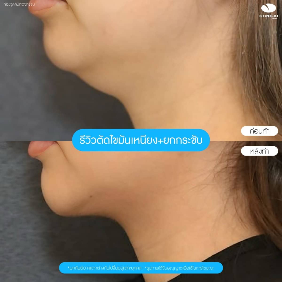 Case 20994 - neck liposuction