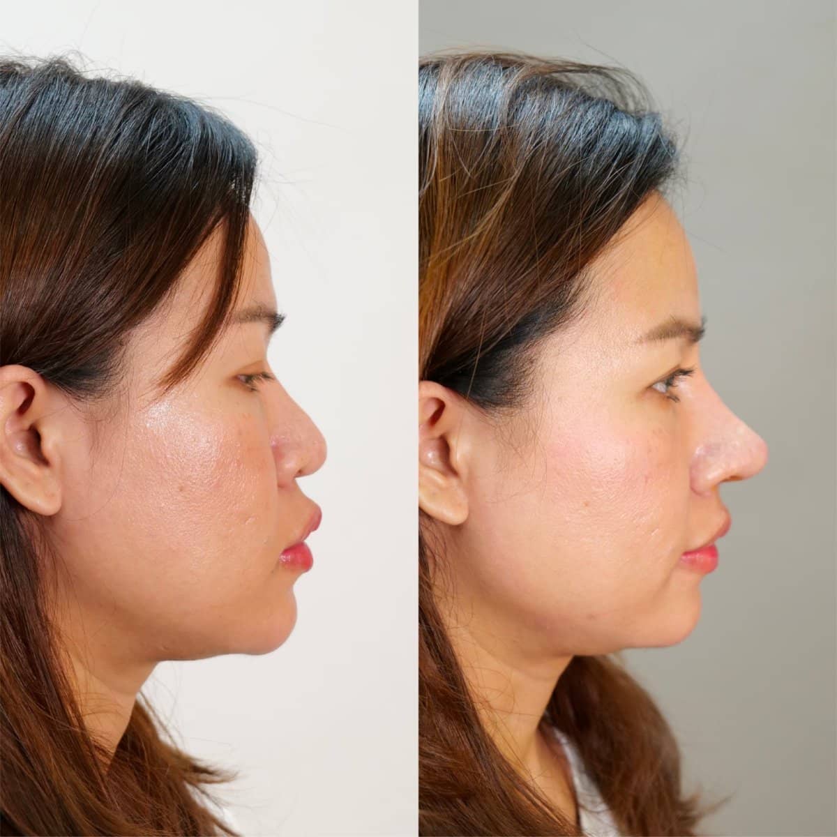 Case 20995 - open rhinoplasty