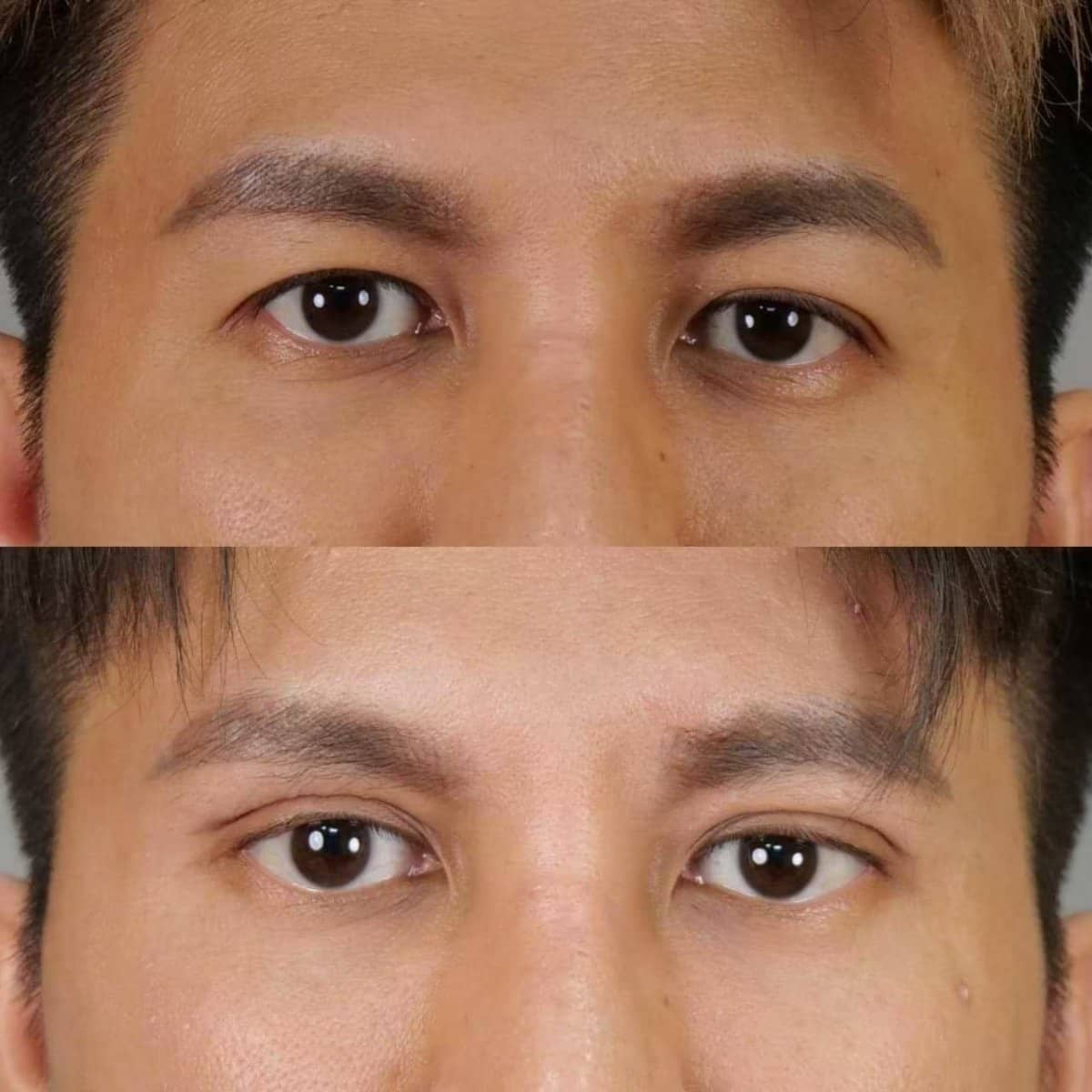 Case 20996 - double eyelid surgery