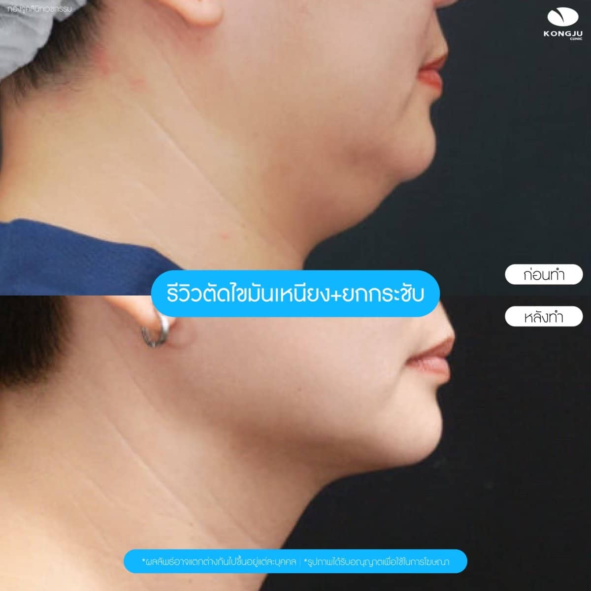 Case 20997 - neck liposuction