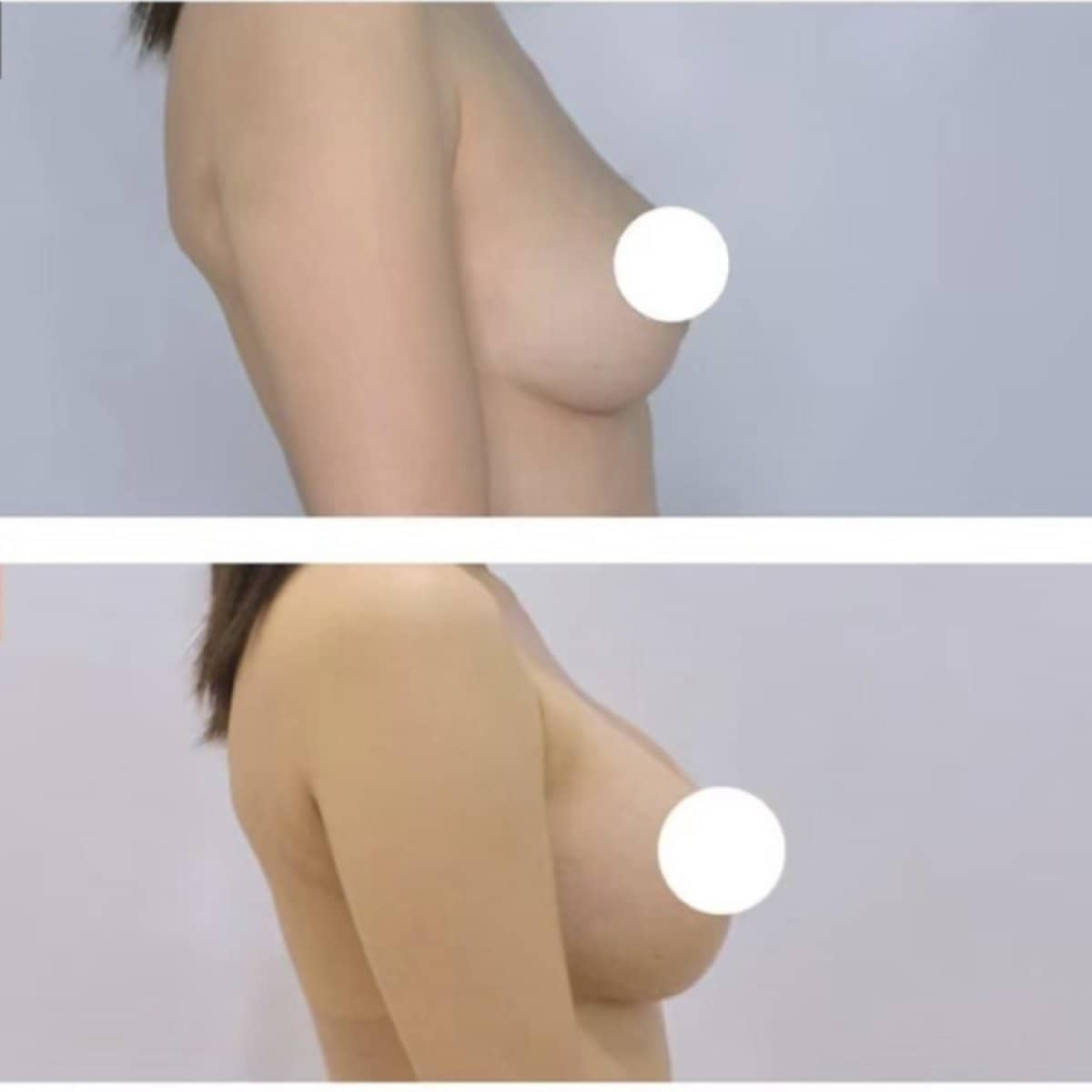 Case 20998 - breast augmentation