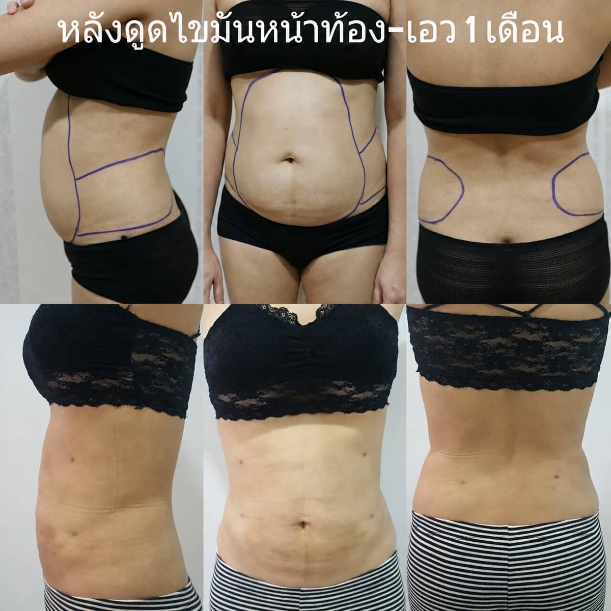 Case 20999 - liposuction