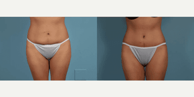Case 210 - Woman treated with Tummy Tuck
