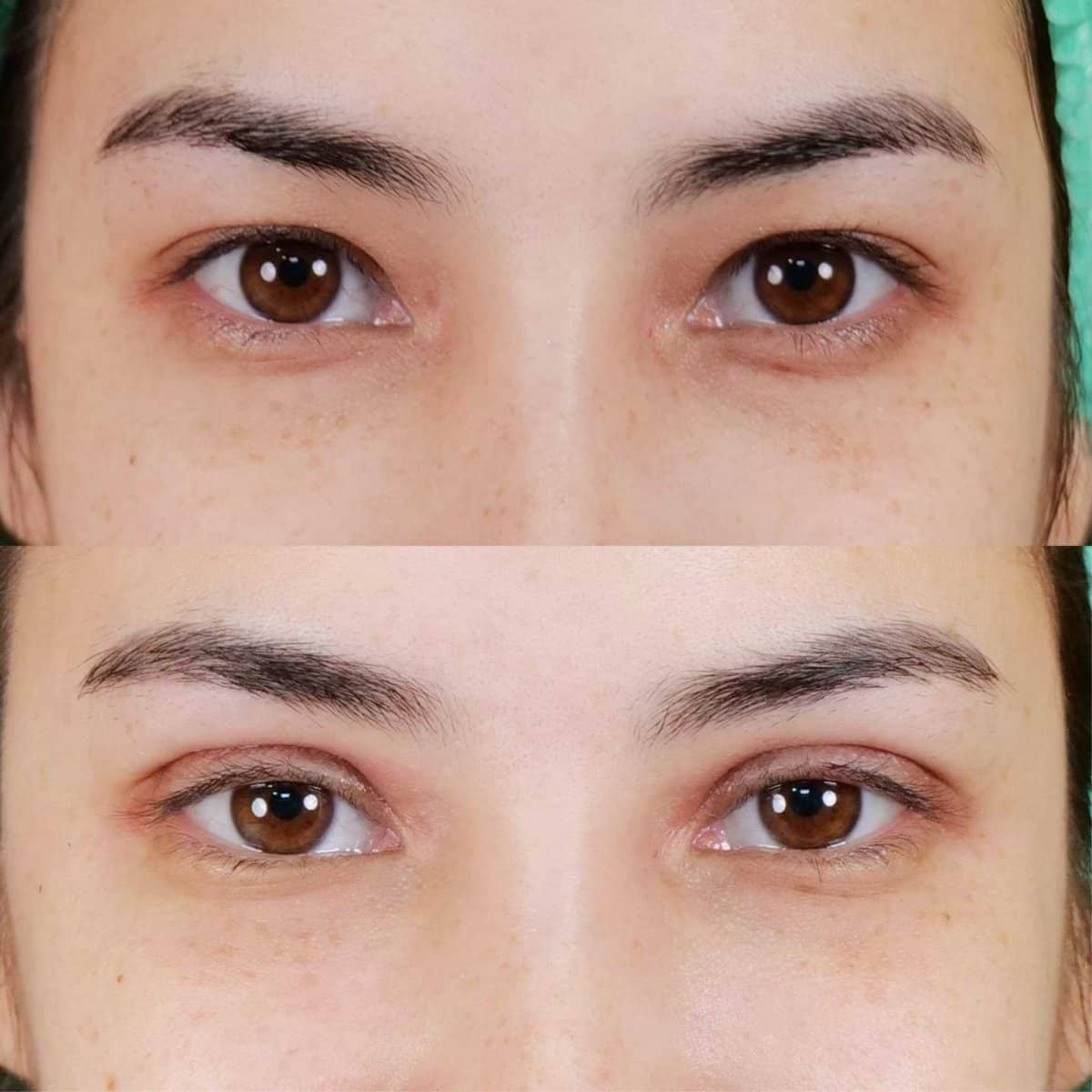 Case 21001 - double eyelid surgery