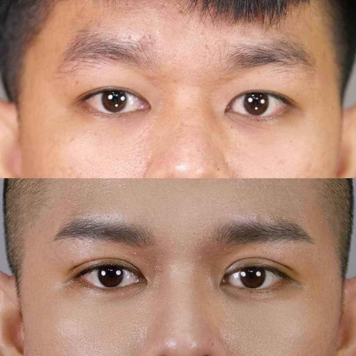 Case 21002 - double eyelid surgery