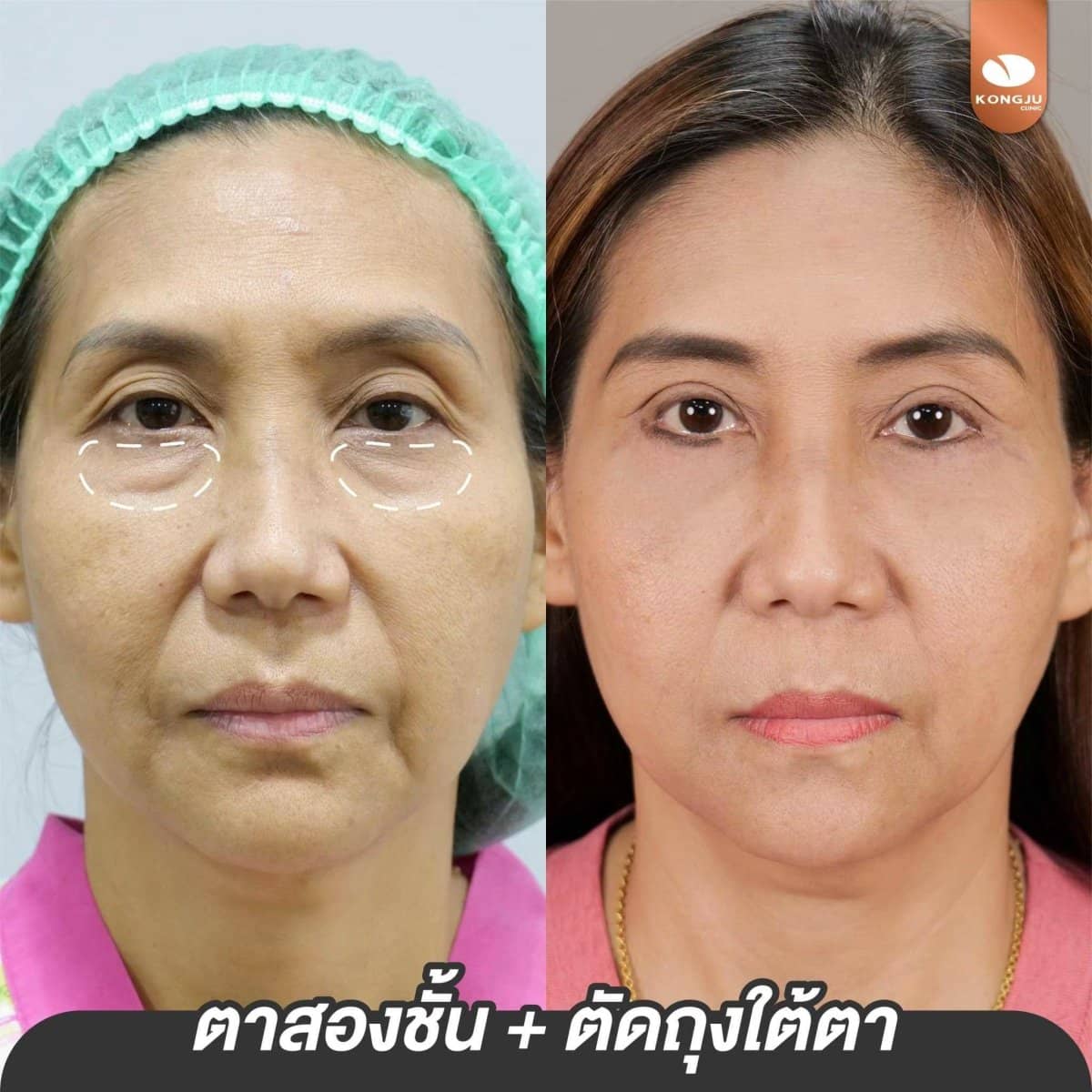 Case 21003 - double eyelid surgery