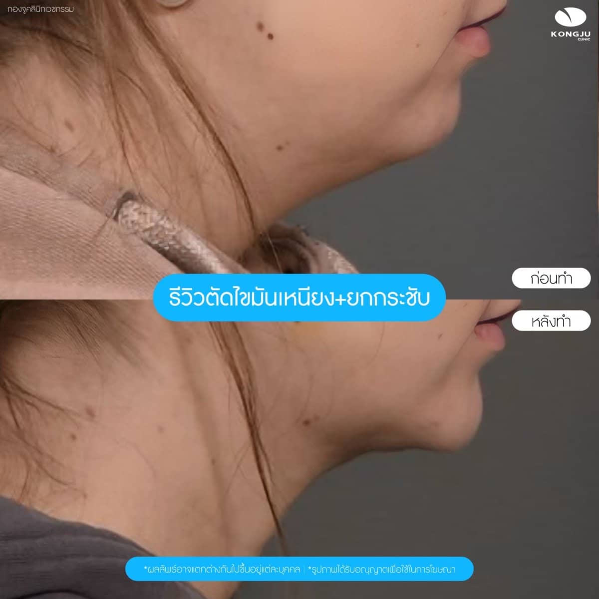Case 21004 - neck liposuction