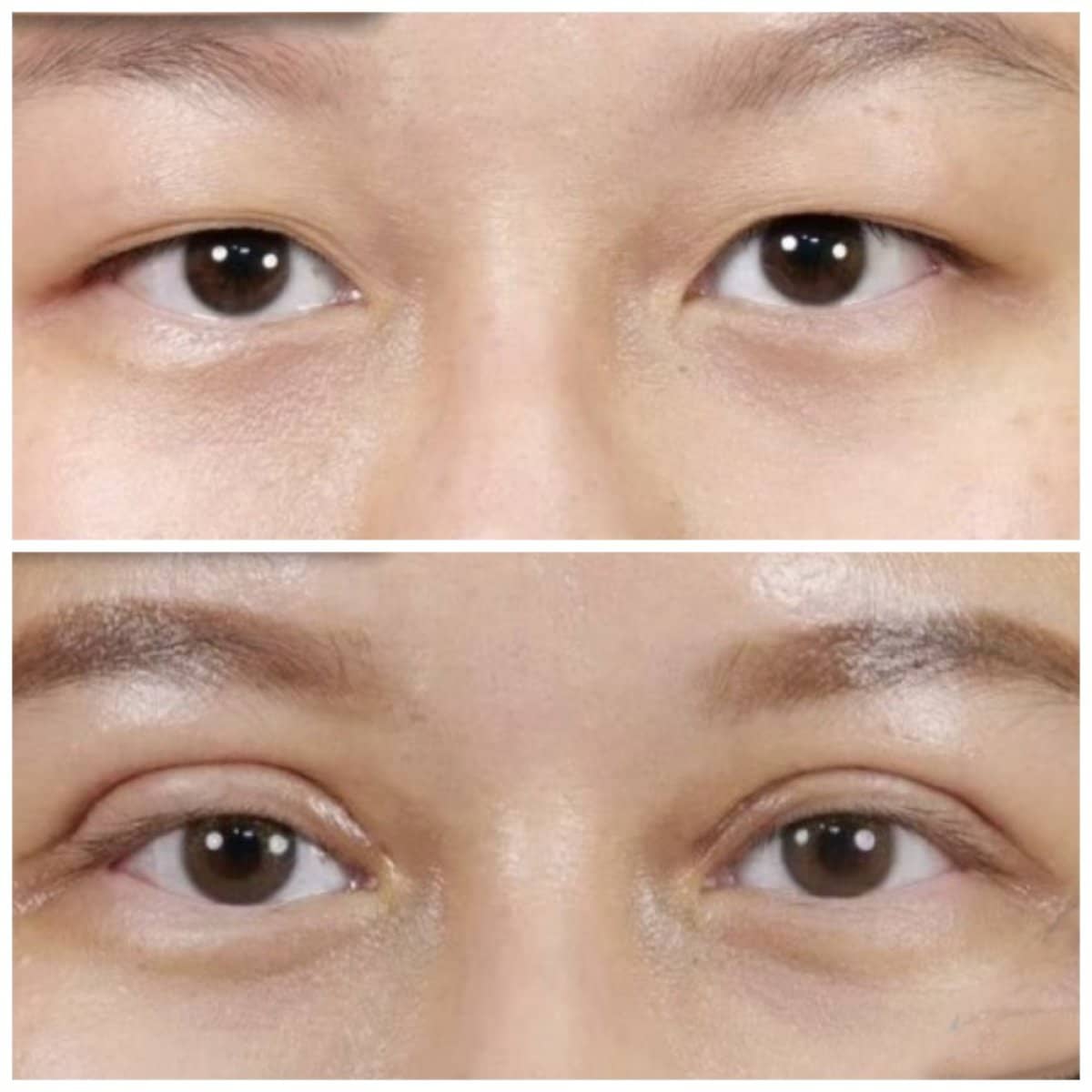 Case 21005 - double eyelid surgery