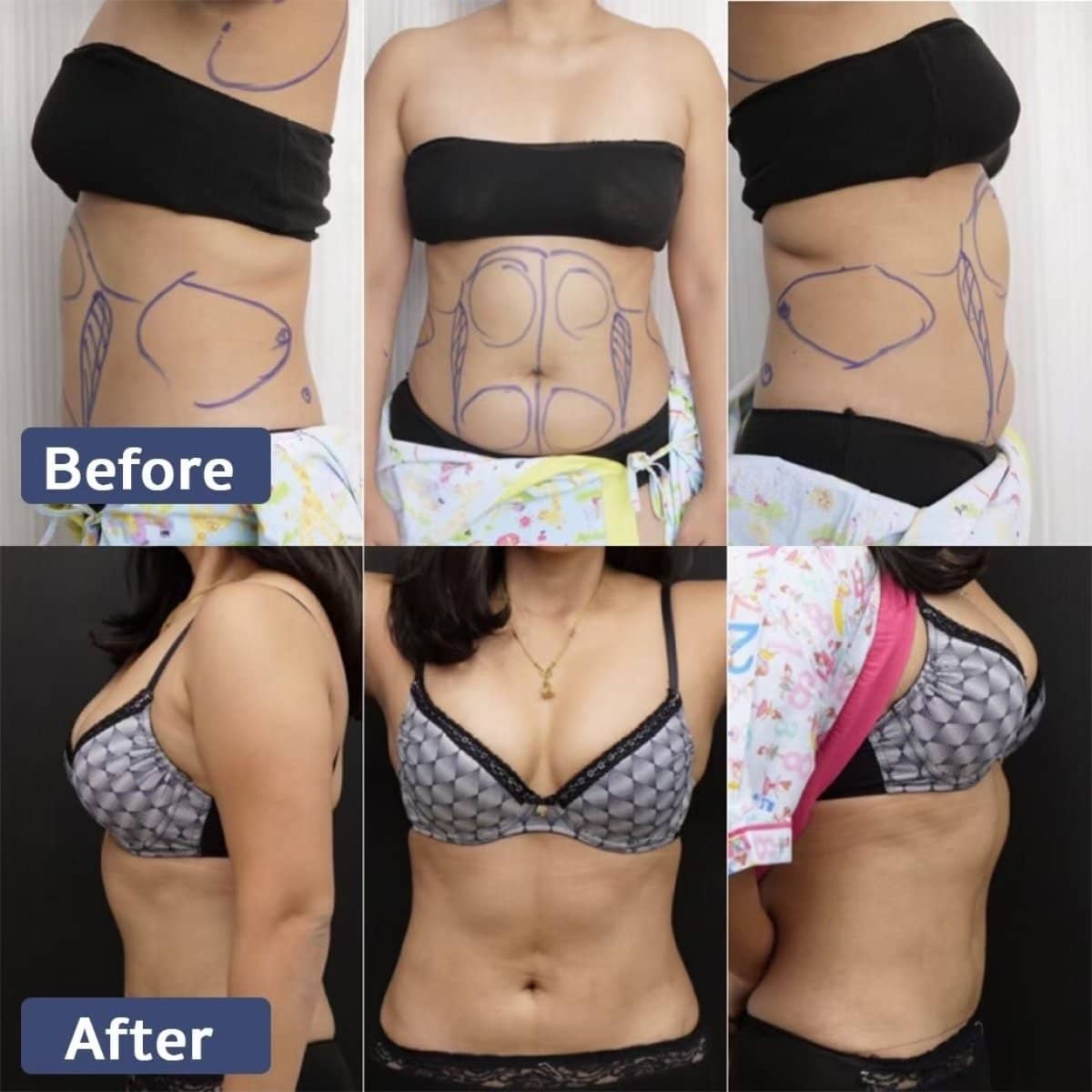 Case 21006 - liposuction