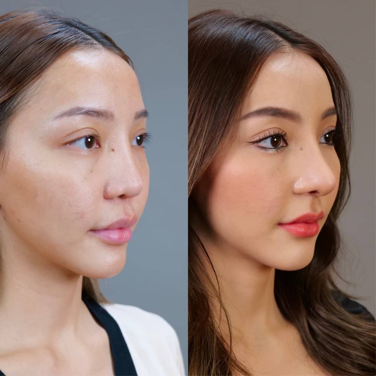 Case 21010 - open rhinoplasty