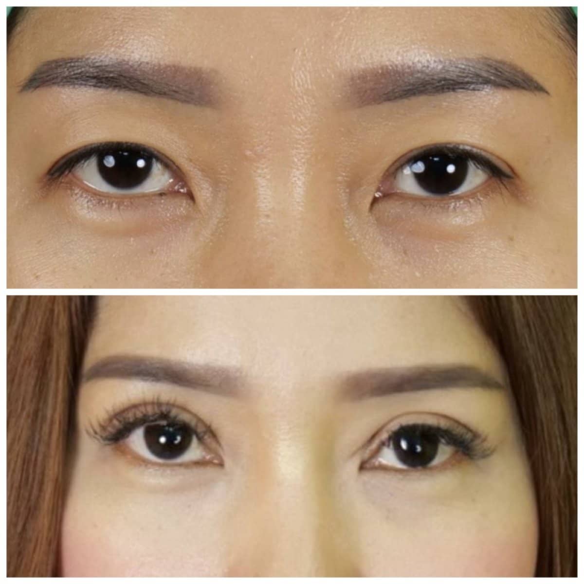 Case 21011 - double eyelid surgery