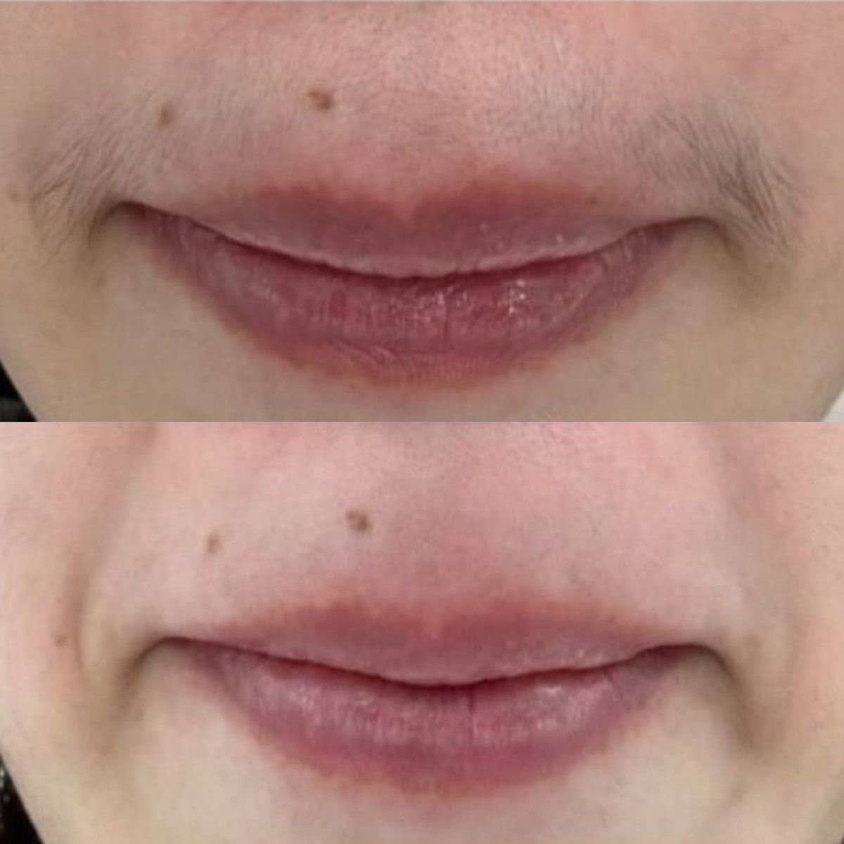 Case 21018 - laser hair removal