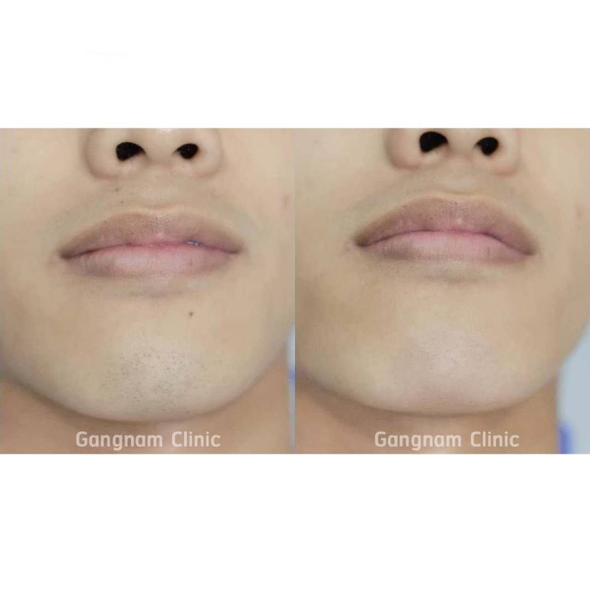 Case 21019 - laser hair removal