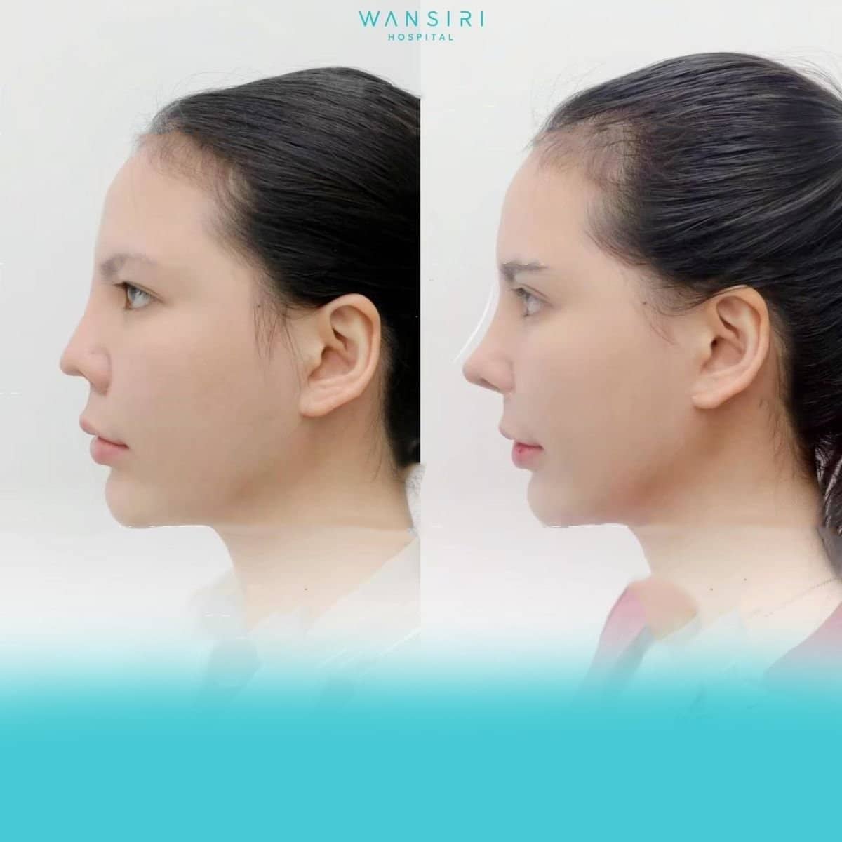 Case 21031 - revision rhinoplasty