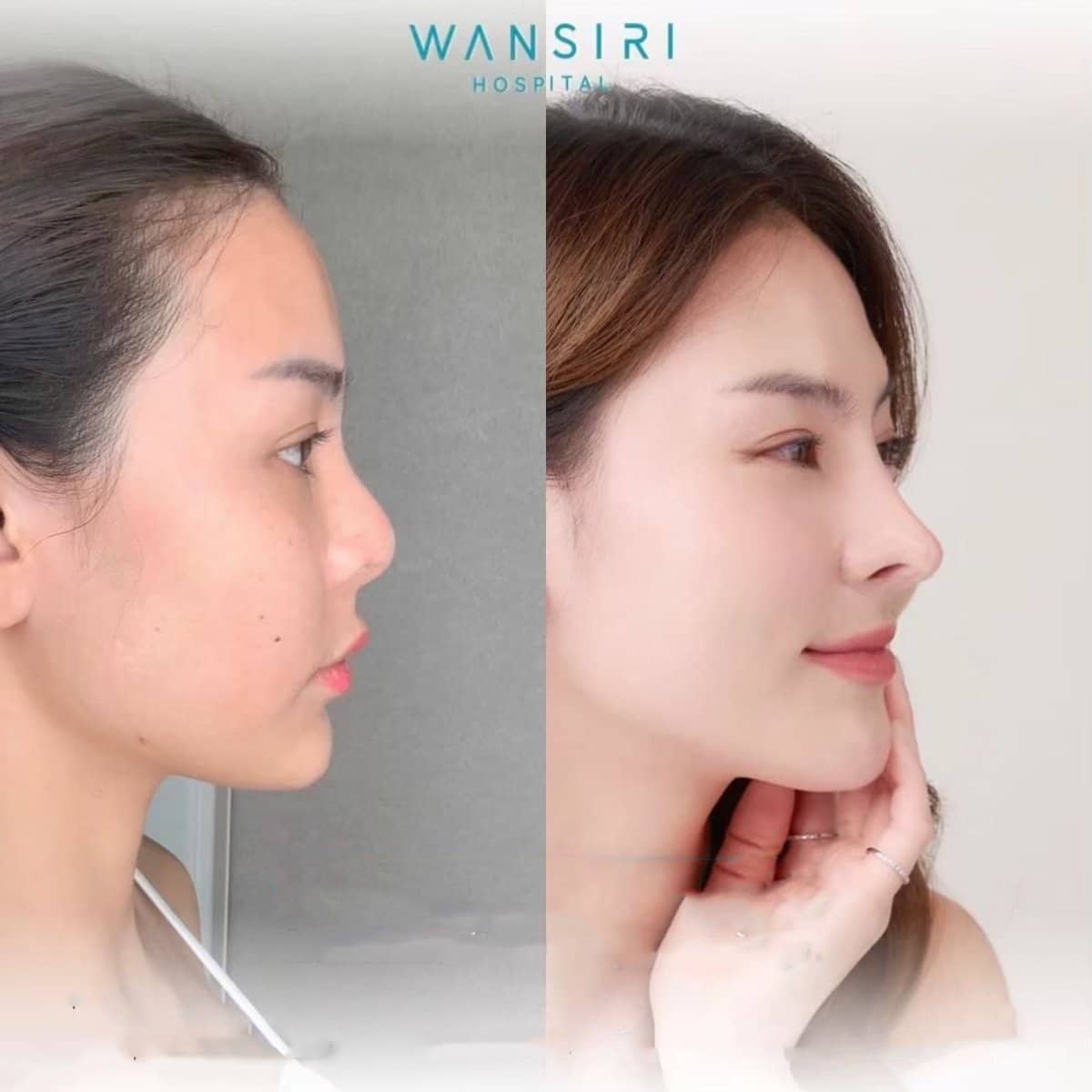 Case 21032 - revision rhinoplasty