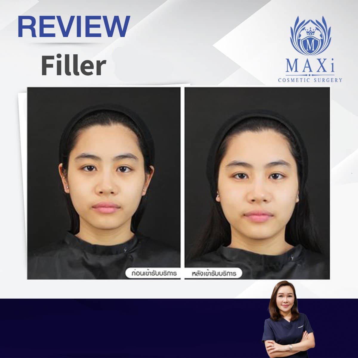 Case 21035 - hyaluronic acid filler
