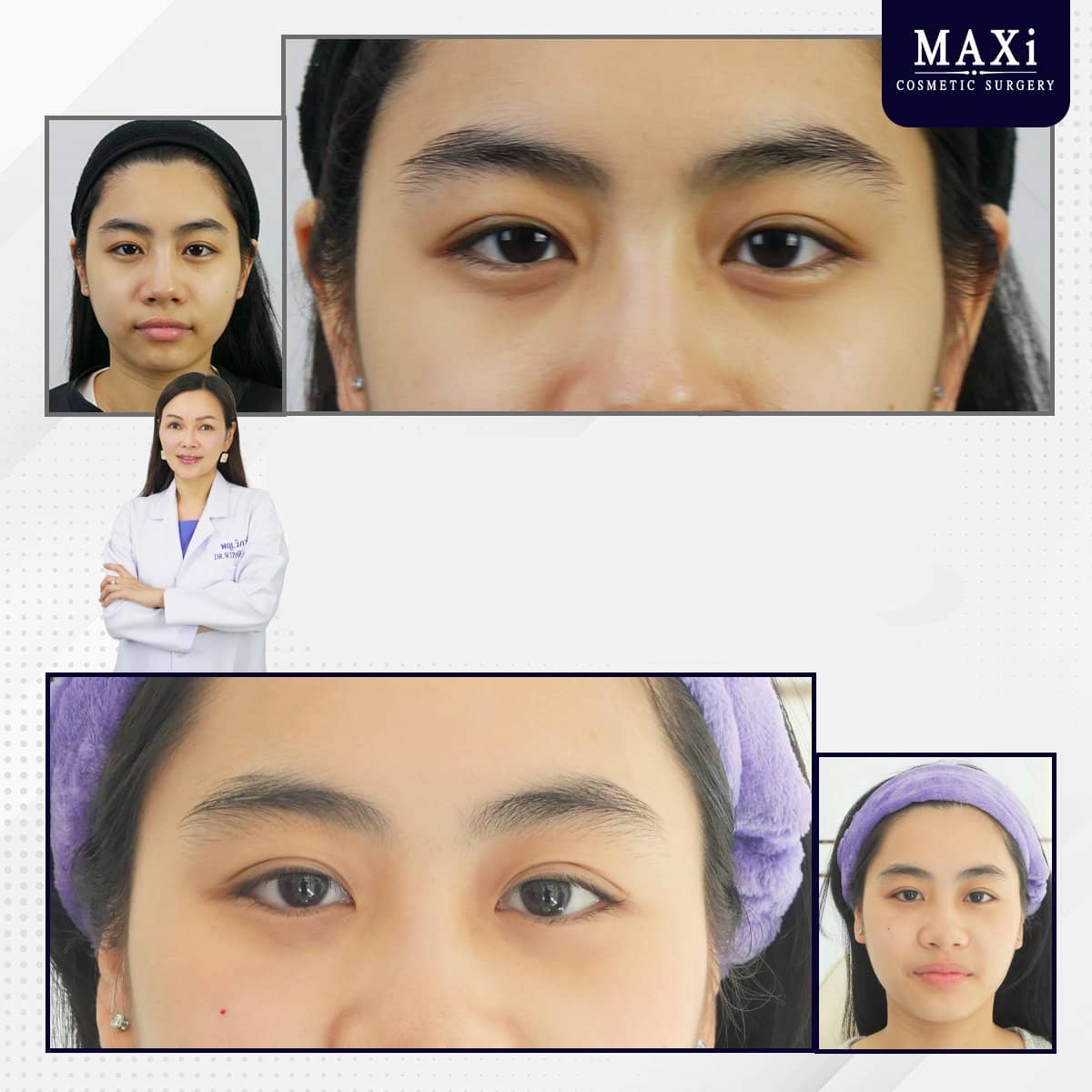 Case 21037 - hyaluronic acid threads lifting