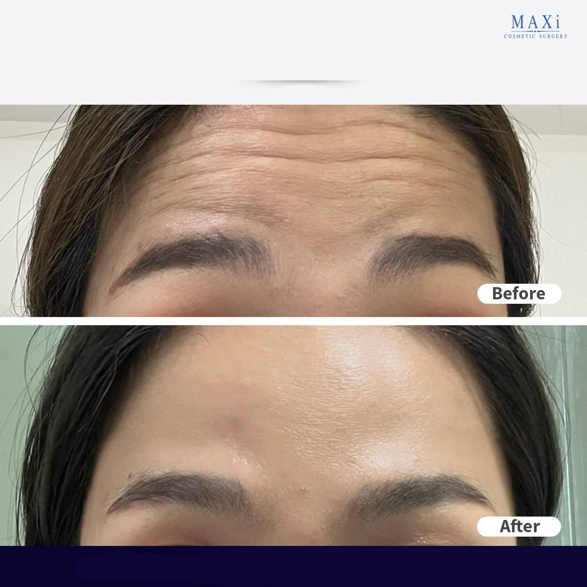Case 21039 - Botox injections