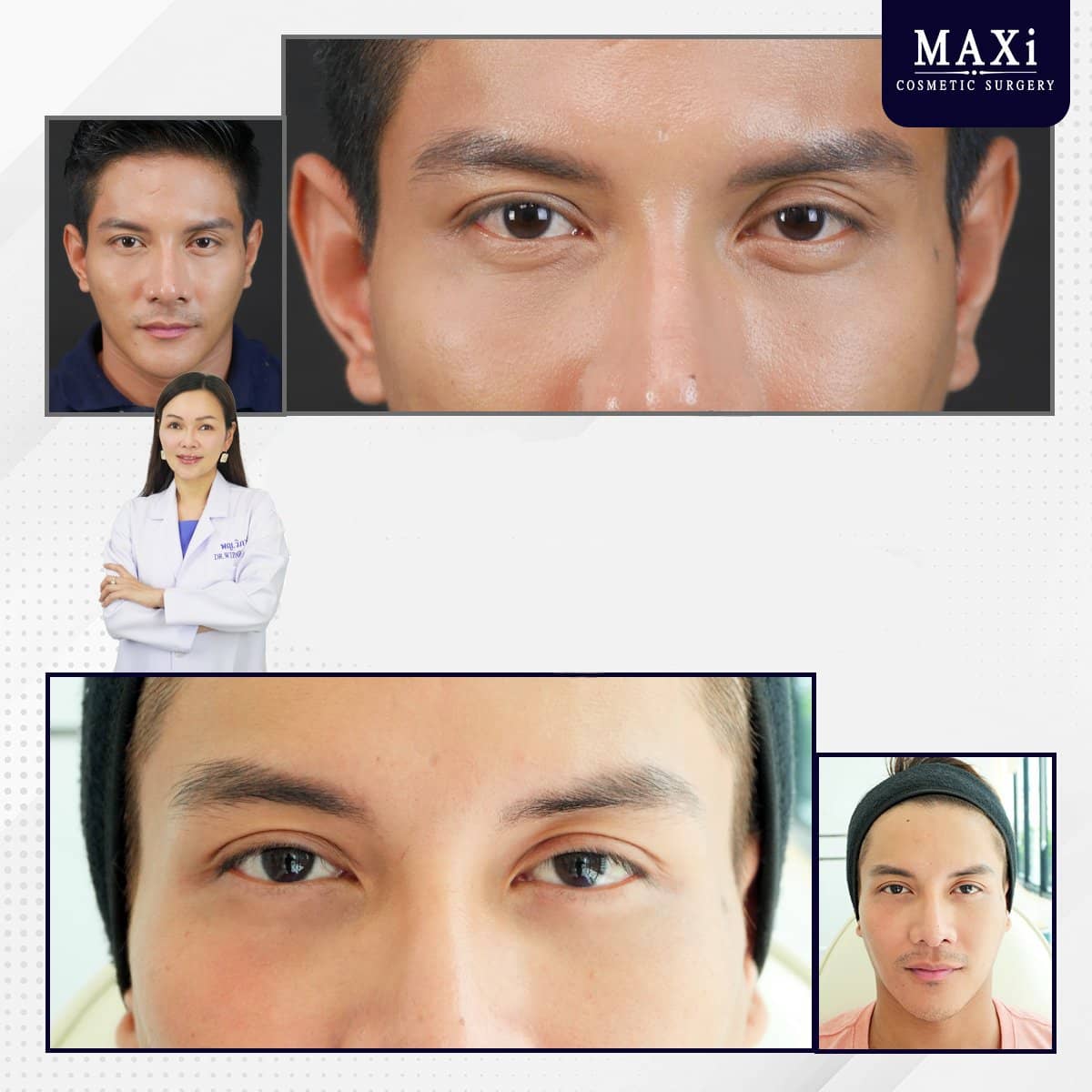 Case 21041 - hyaluronic acid threads lifting