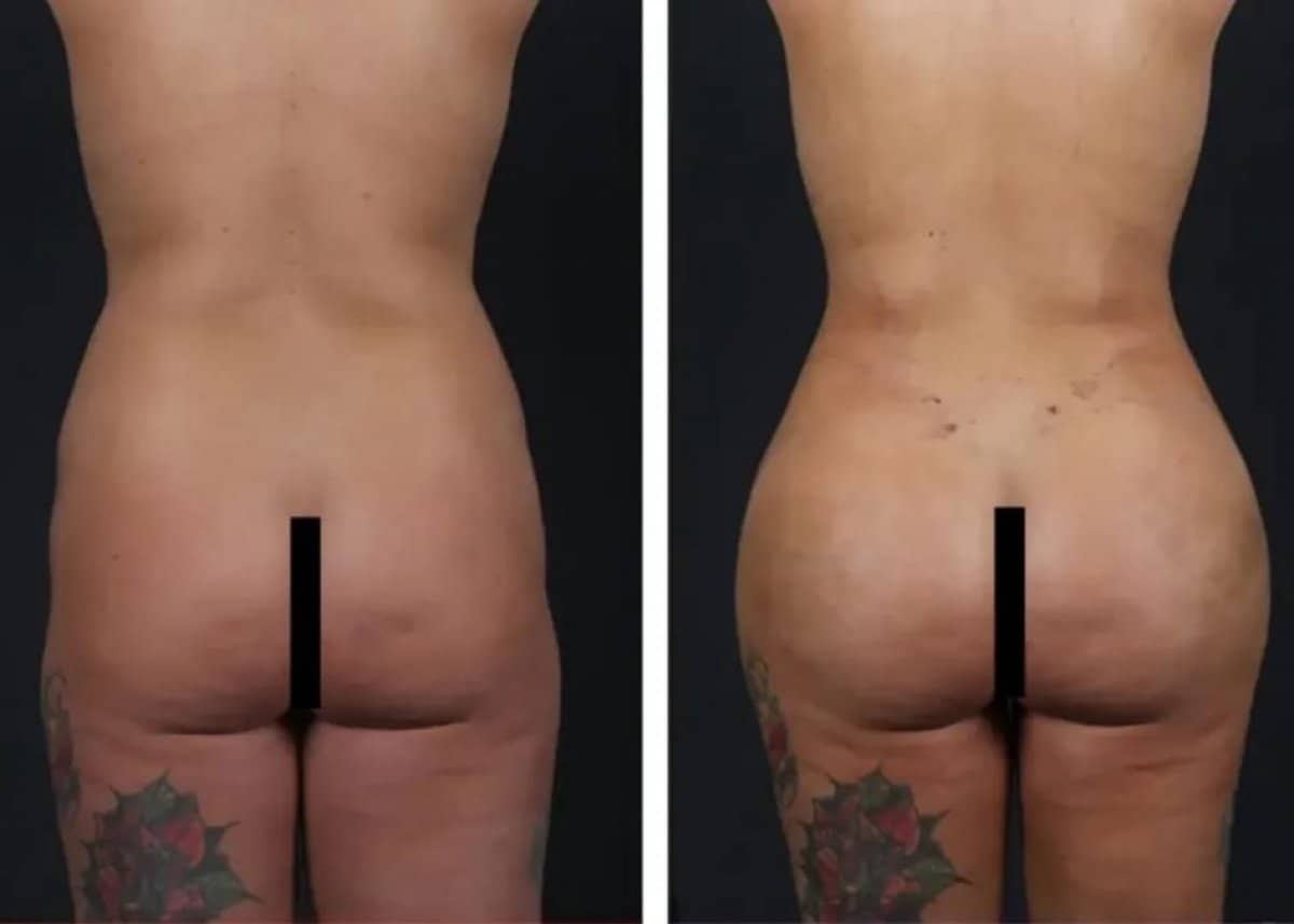 Case 21097 - butt implants