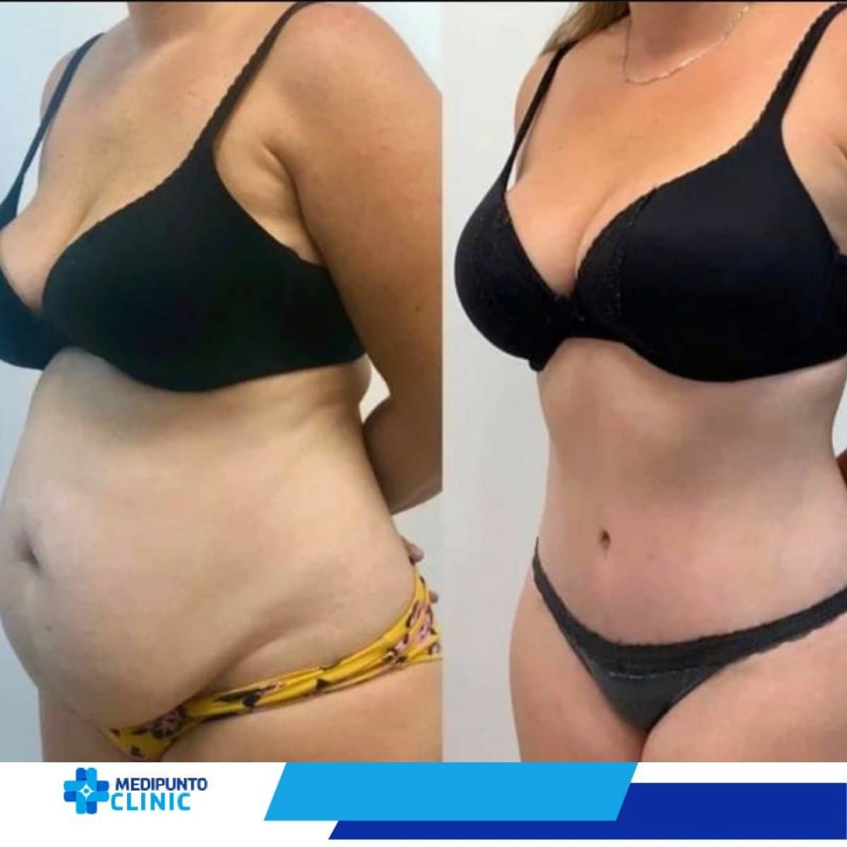 Case 21098 - tummy tuck and liposuction