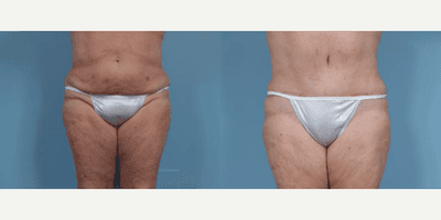 Case 211 - Woman treated with Tummy Tuck