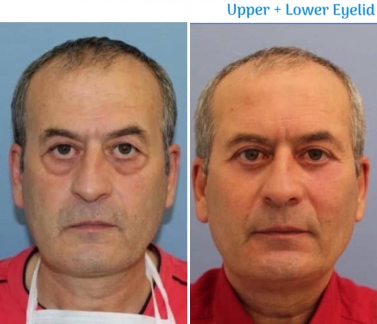 Case 21100 - blepharoplasty