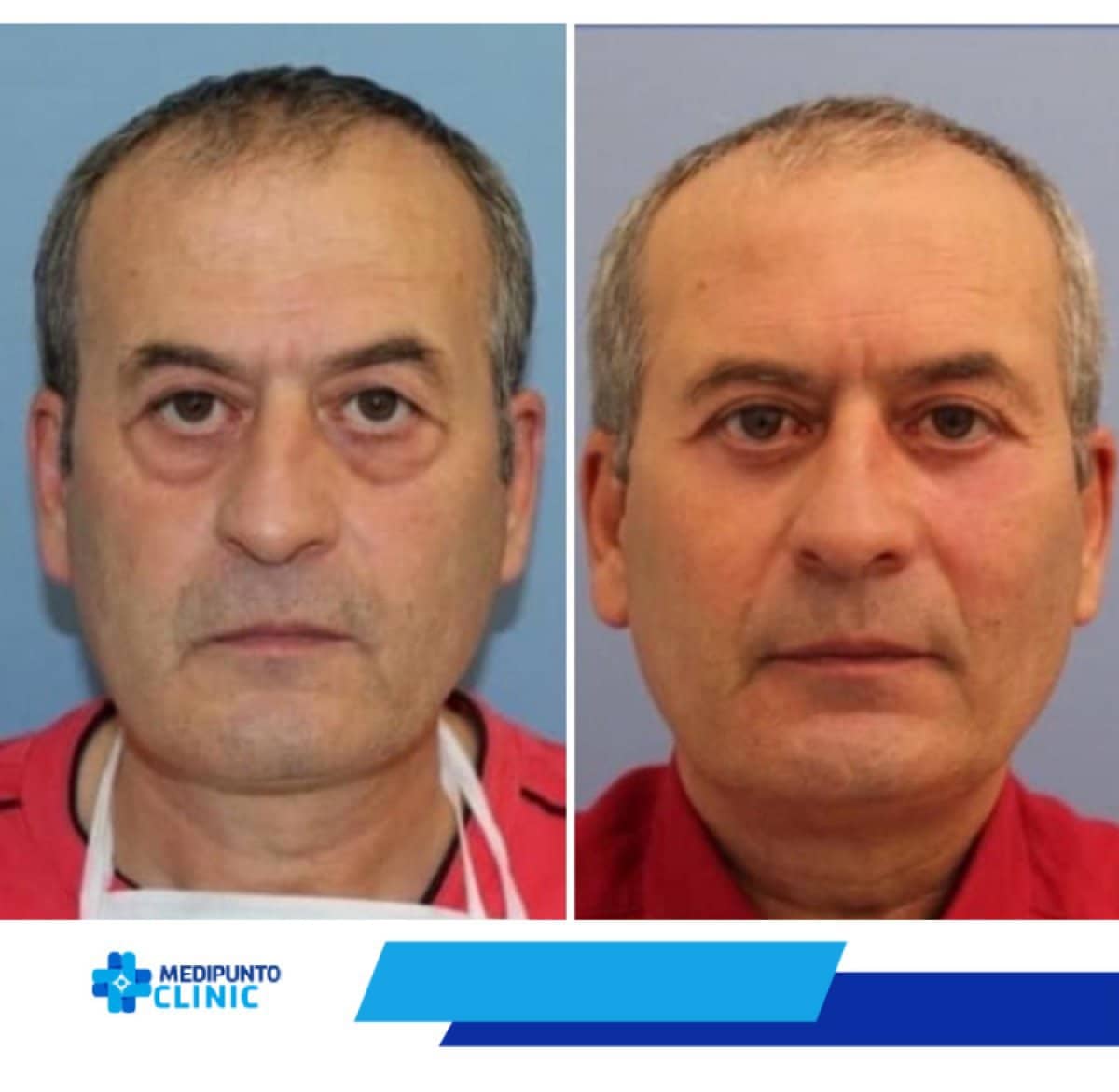 Case 21101 - blepharoplasty