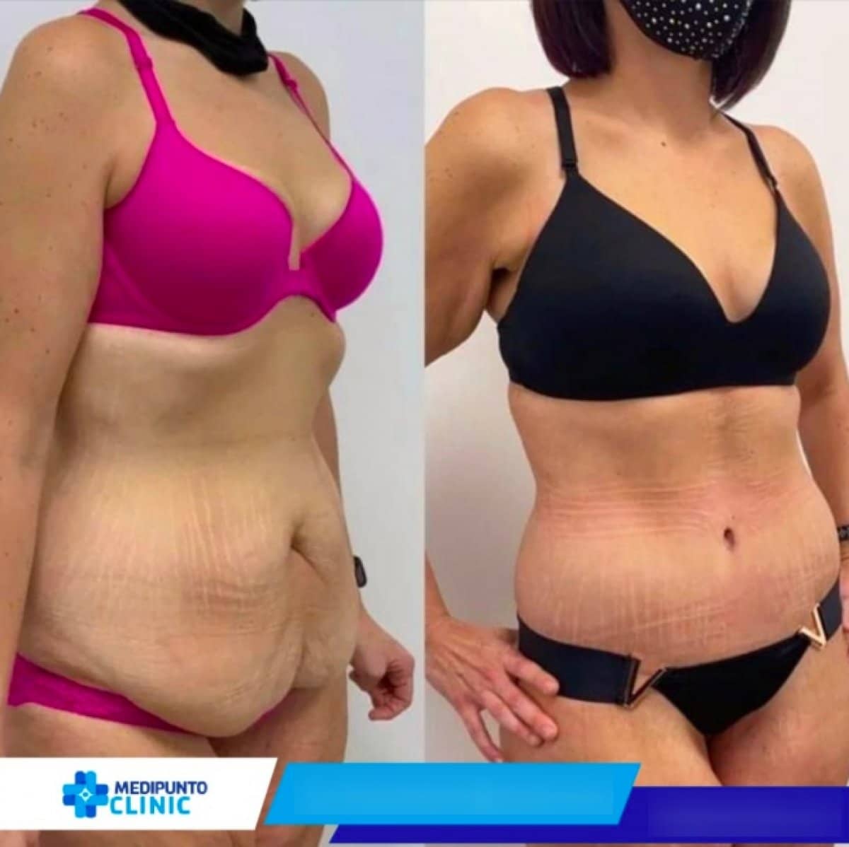 Case 21105 - liposuction