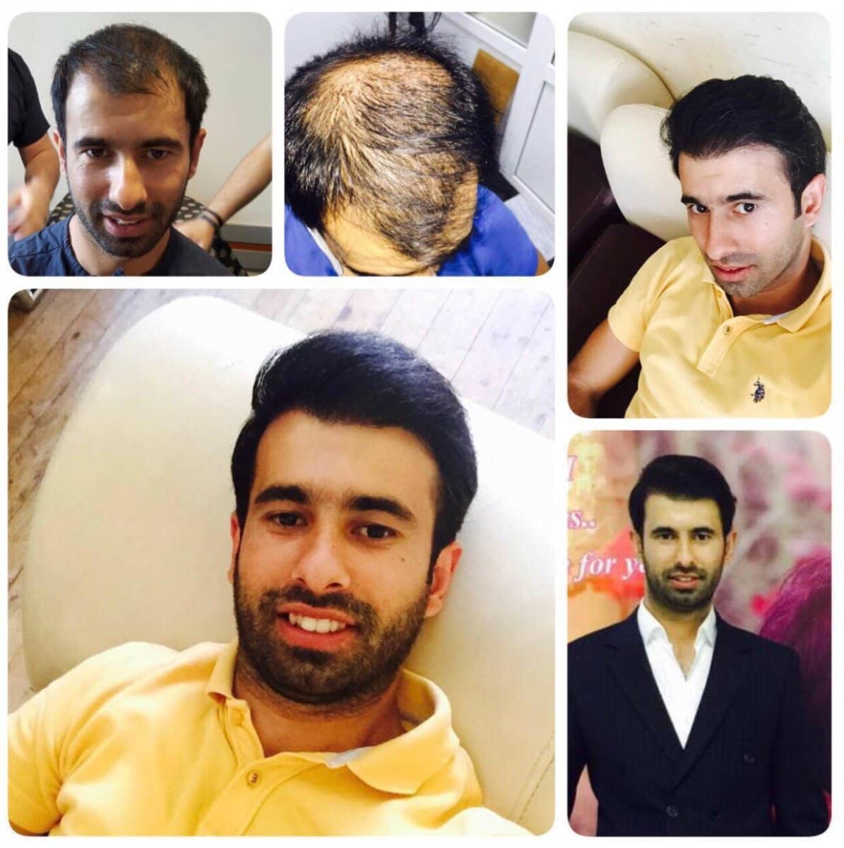 Case 21106 - hair transplant