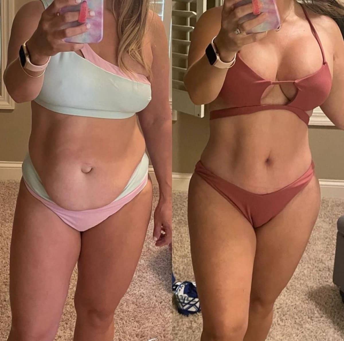 Case 21108 - tumescent liposuction