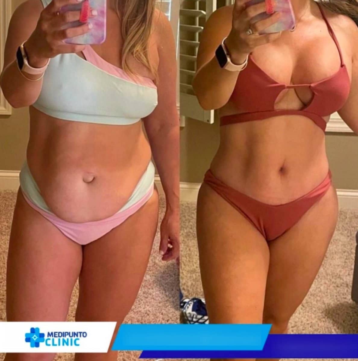 Case 21110 - tummy tuck and liposuction