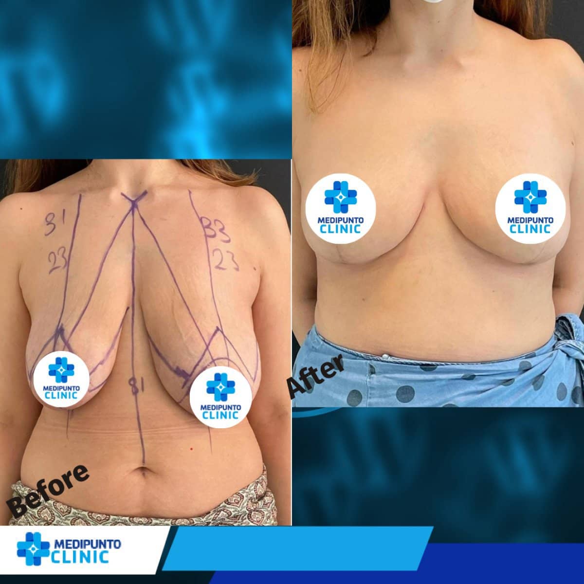 Case 21111 - breast lift