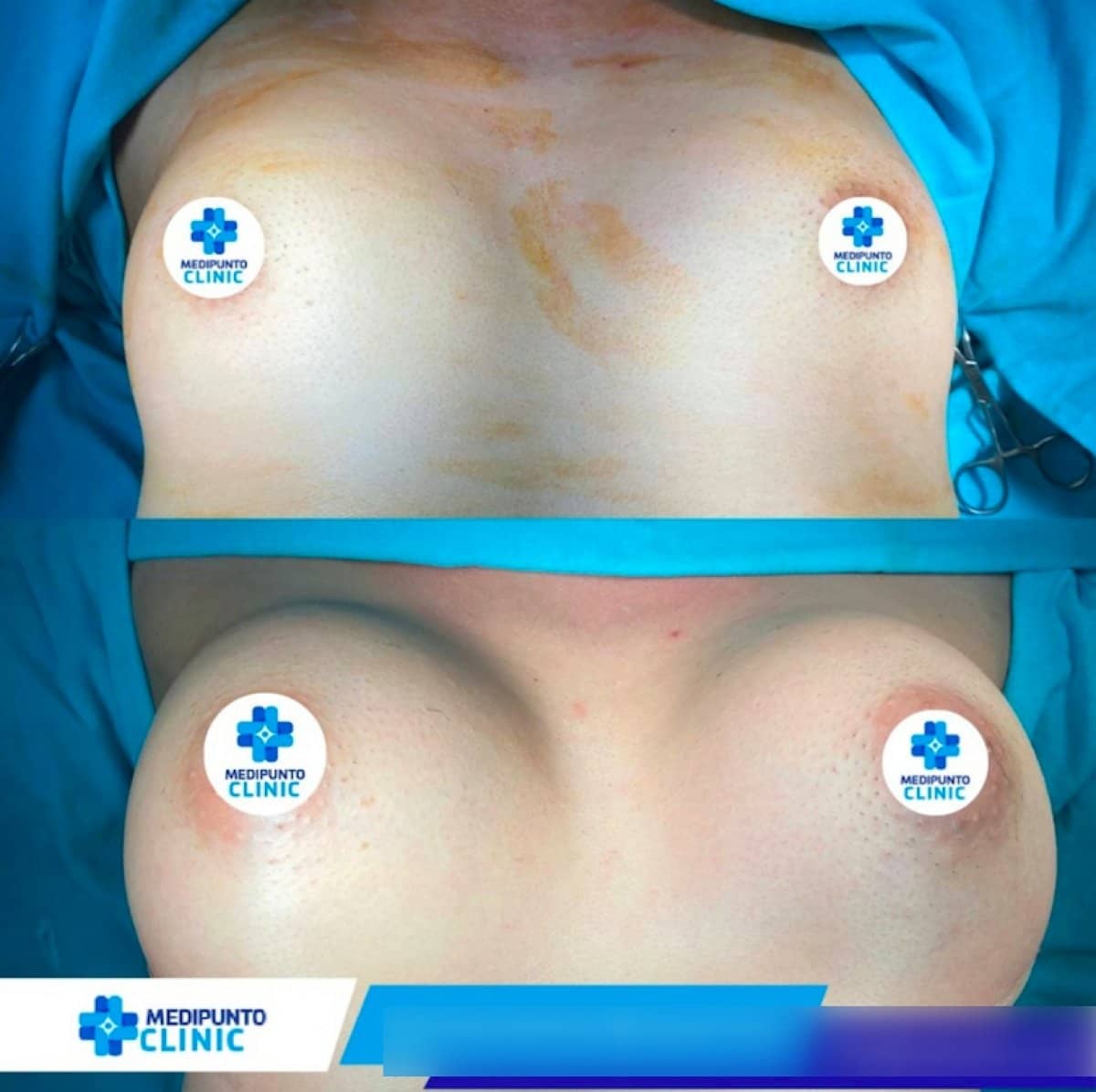 Case 21118 - breast augmentation