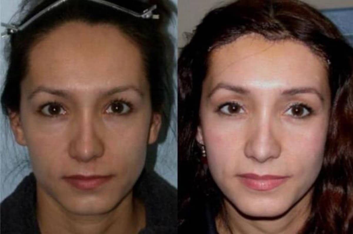 Case 21122 - blepharoplasty