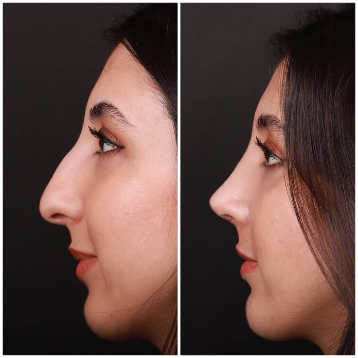 Case 21130 - rhinoplasty