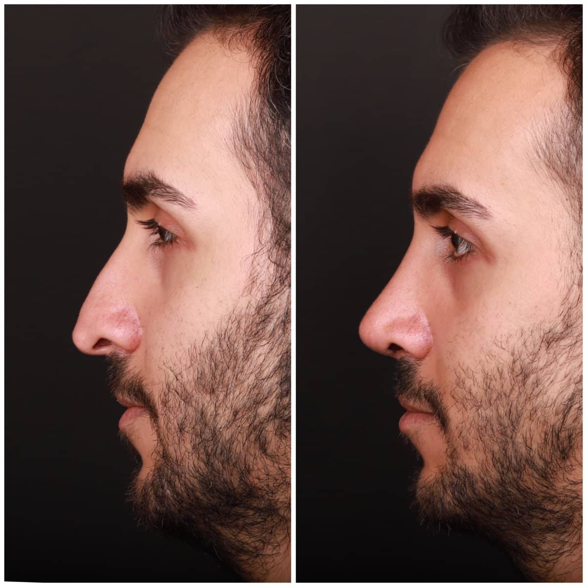 Case 21131 - rhinoplasty