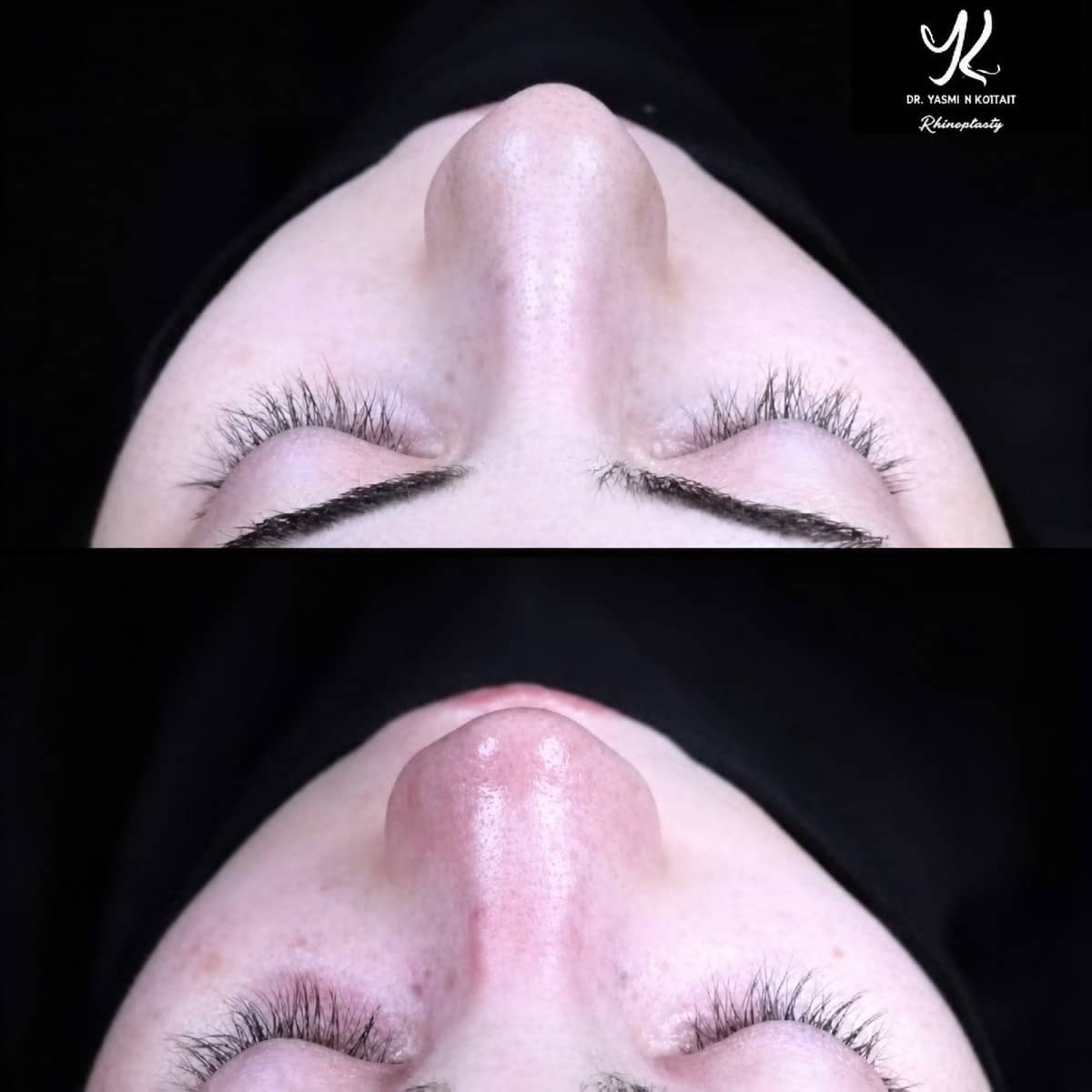 Case 21132 - tip rhinoplasty