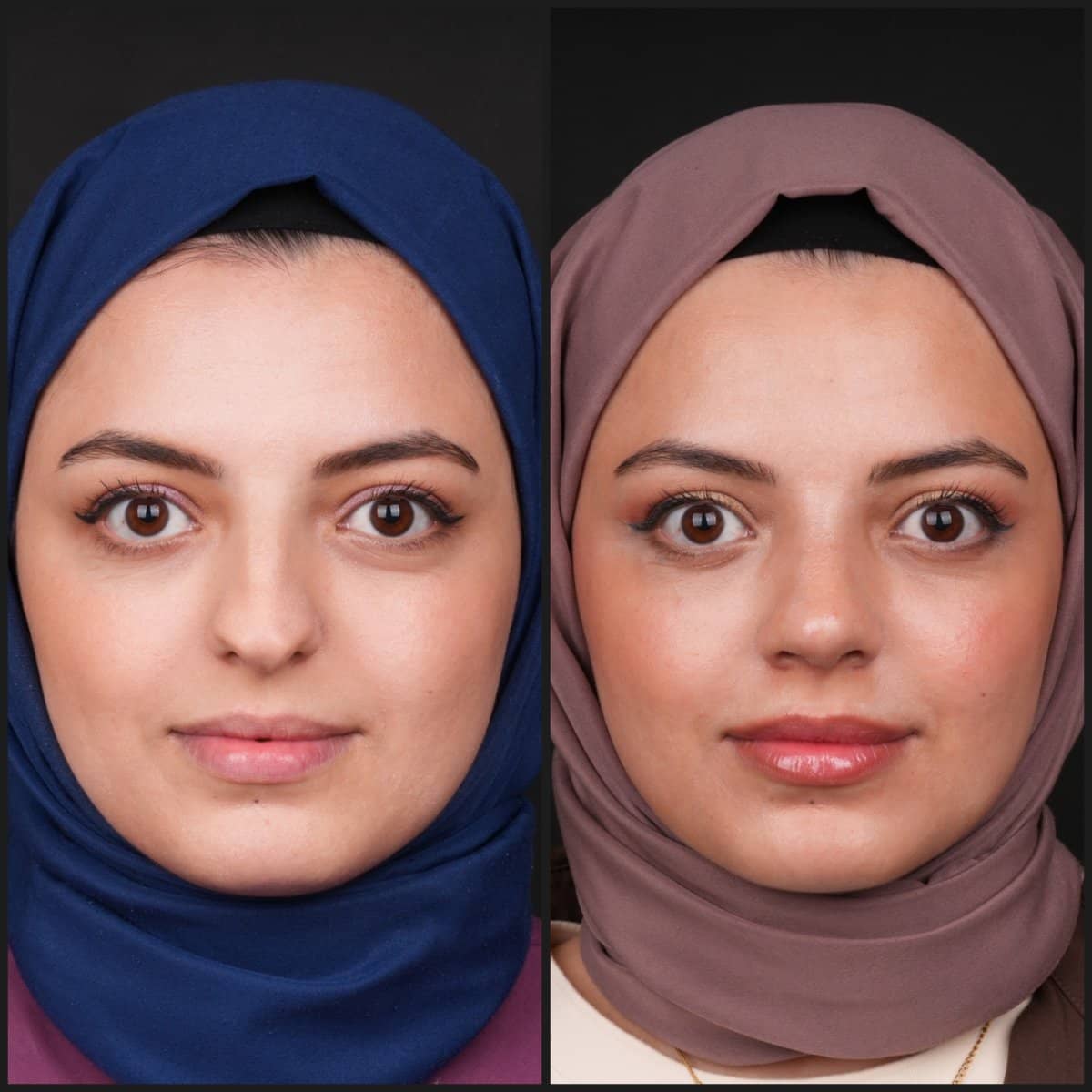 Case 21133 - rhinoplasty