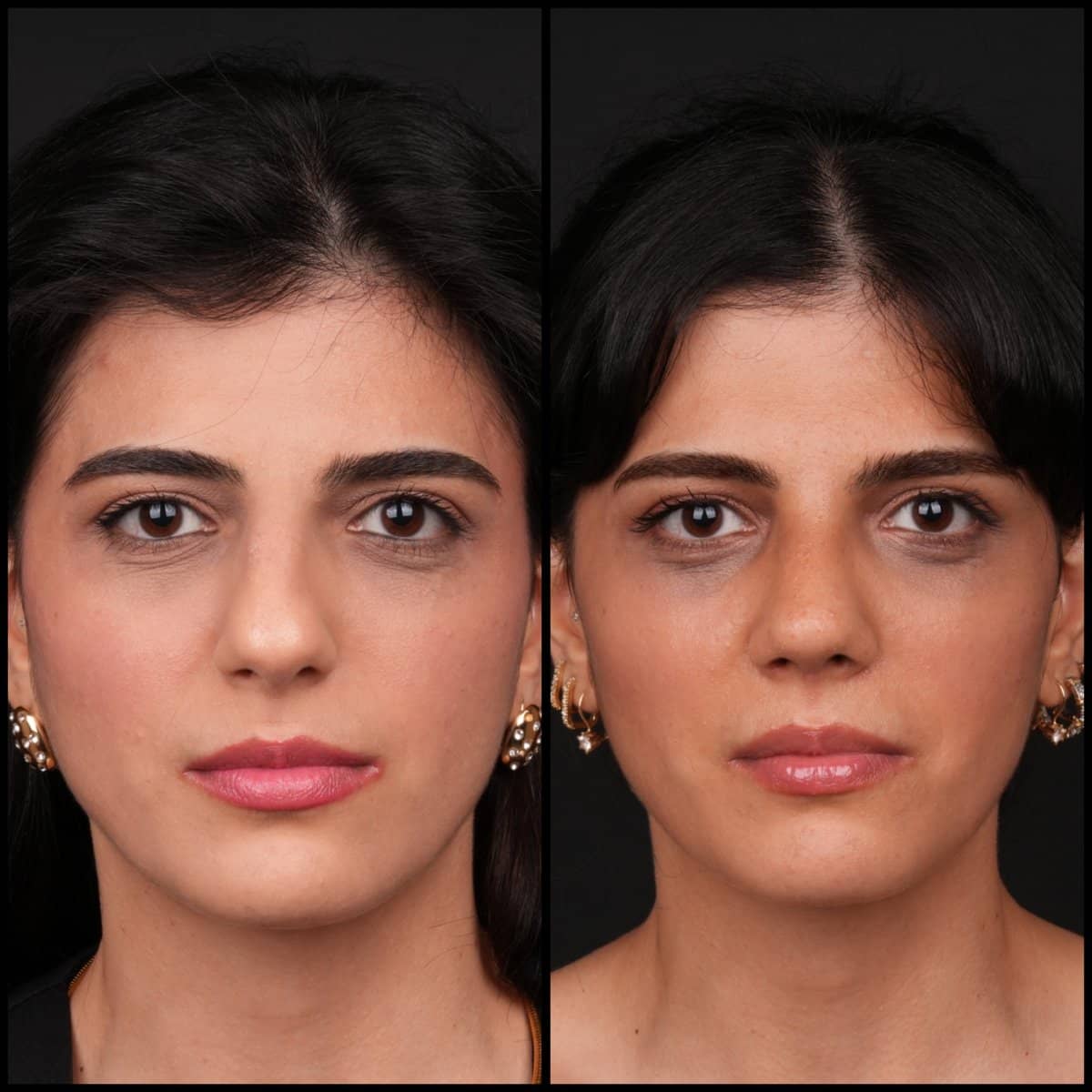 Case 21134 - rhinoplasty