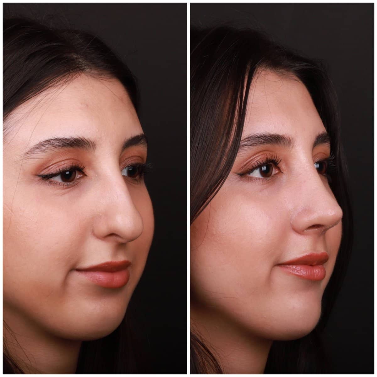 Case 21135 - rhinoplasty