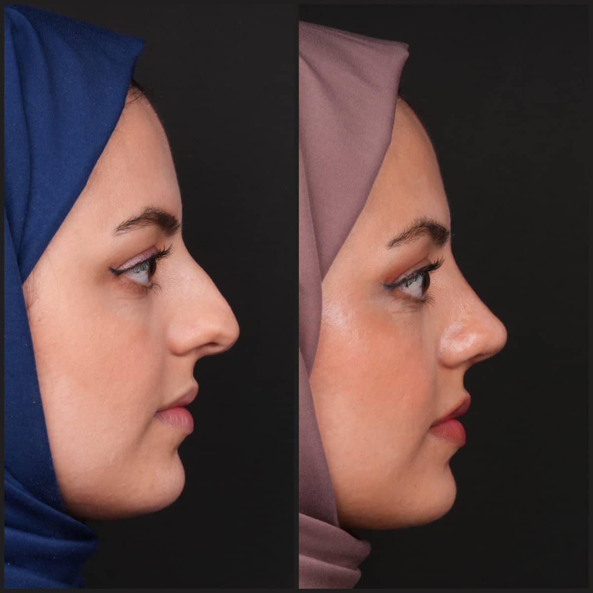 Case 21136 - rhinoplasty