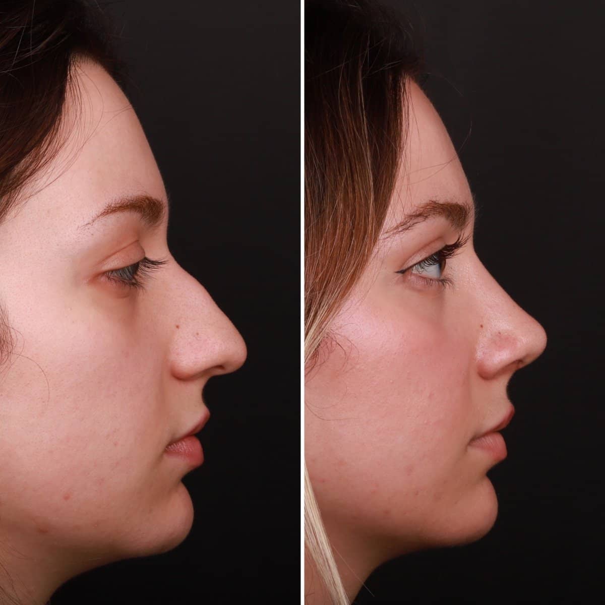 Case 21137 - rhinoplasty