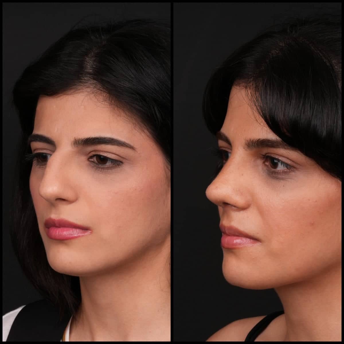 Case 21138 - rhinoplasty