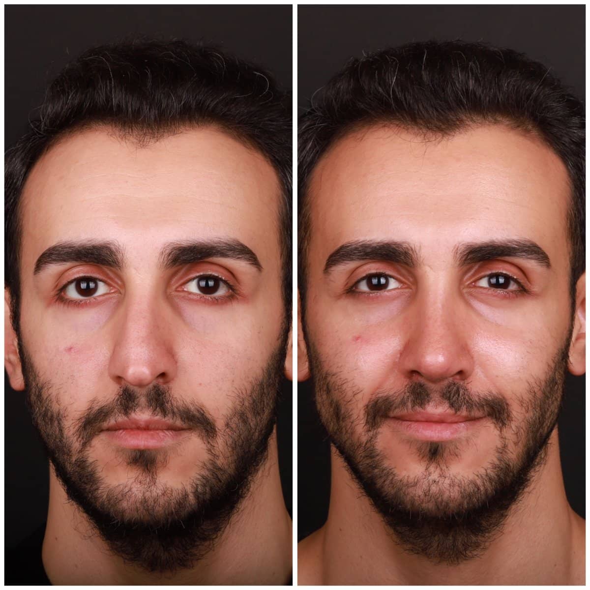 Case 21139 - rhinoplasty