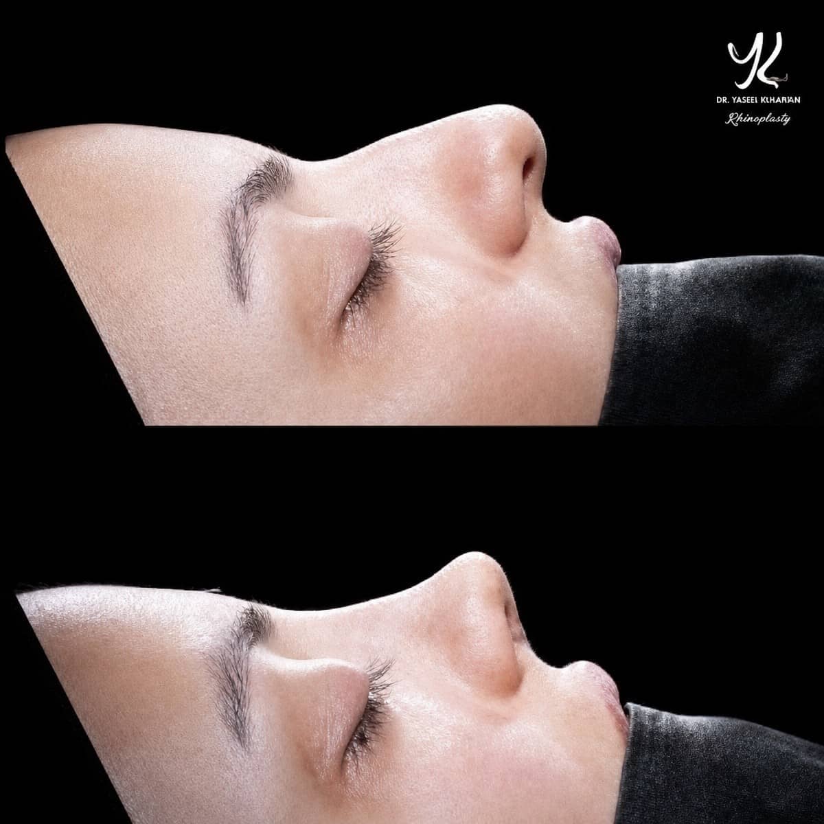 Case 21140 - tip rhinoplasty