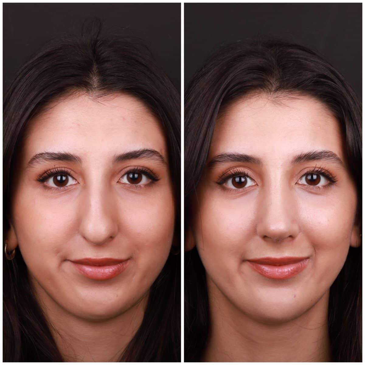 Case 21141 - rhinoplasty