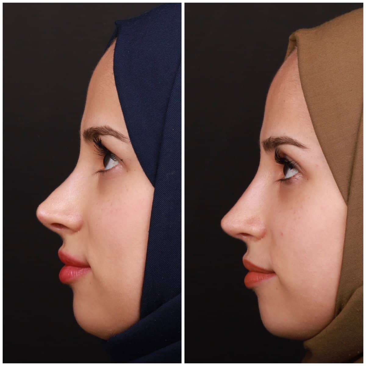 Case 21142 - revision rhinoplasty