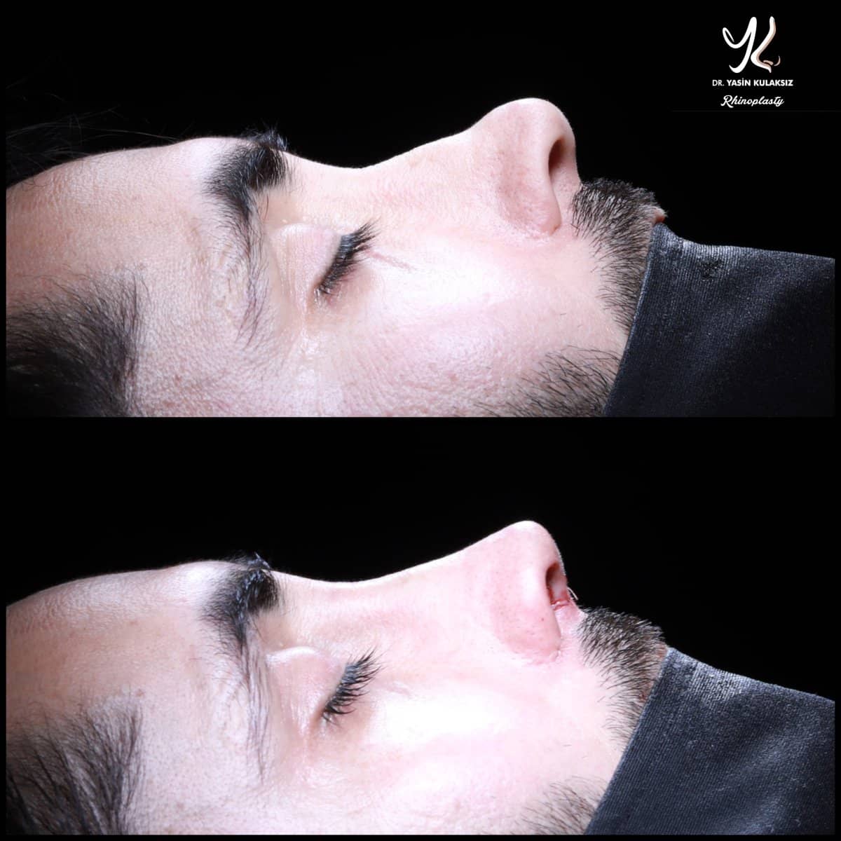 Case 21143 - revision rhinoplasty